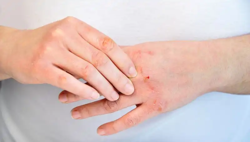 Yetersiz Protein Tüketimi: Vücudunuzun Sizi Uyardığı 6 Belirti